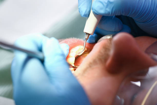 Best Emergency Treatment for Dental Infections or Abscesses in Dresden, TN
