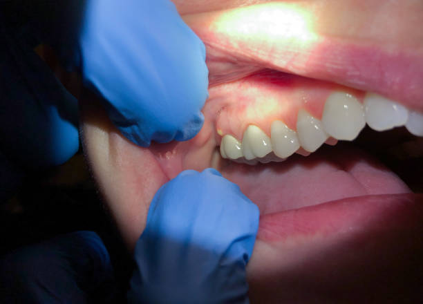 Best Emergency Denture Repair in Dresden, TN