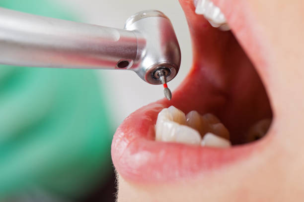 Best Emergency Tooth Extraction in Dresden, TN
